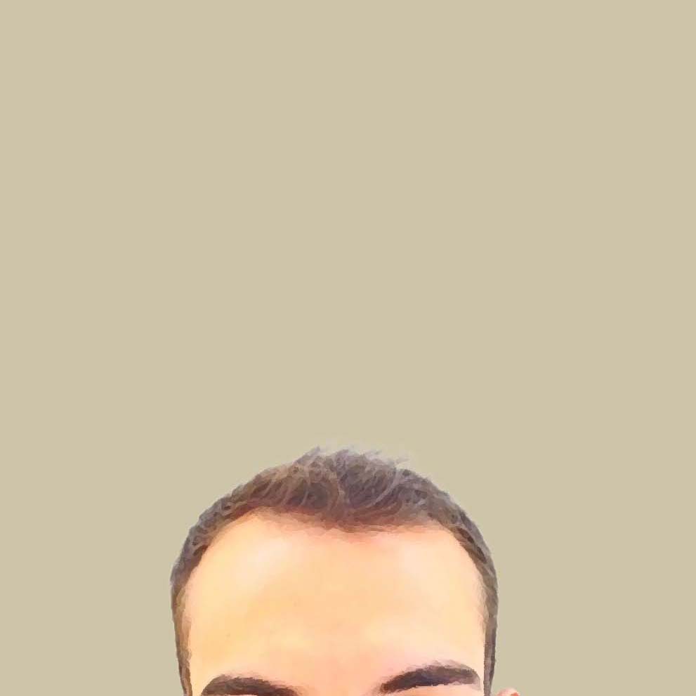 saç ekimi öncesi sonrası