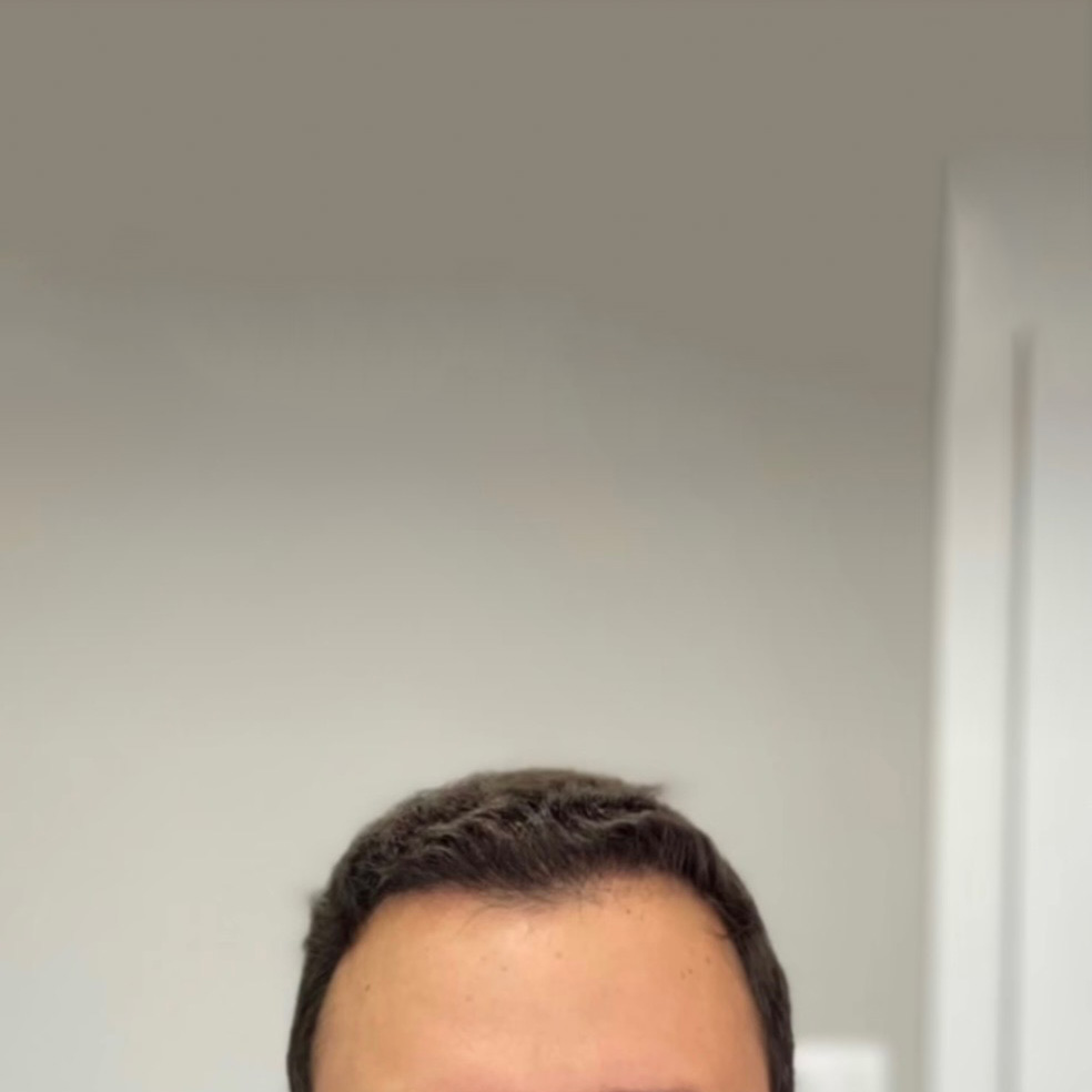 saç ekimi öncesi sonuçları